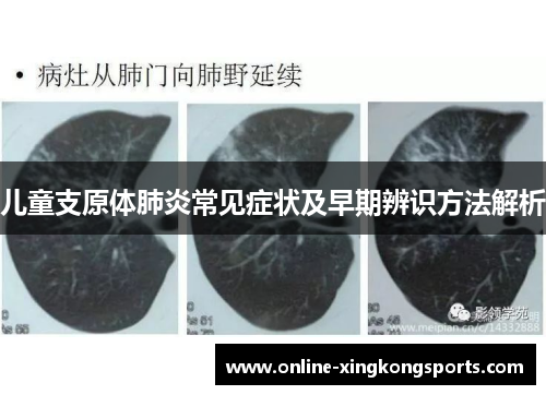 儿童支原体肺炎常见症状及早期辨识方法解析